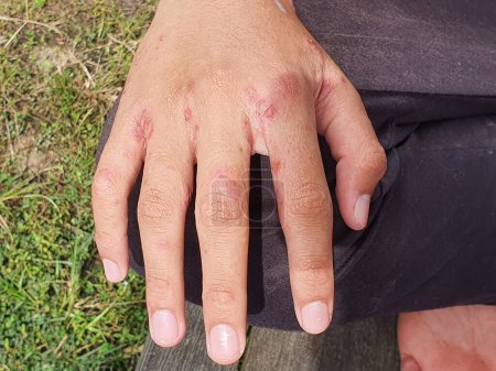 Foto de Close up of hand with with ulcer filled with pus condition caused of scabies infection, sensitive skin itchy health problem - Imagen libre de derechos