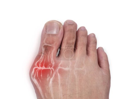 Foto de Primer plano del pie con problema juanete, hallux valgus, composición digital de dedos humanos con inflamación roja, cortado aislado en blanco - Imagen libre de derechos