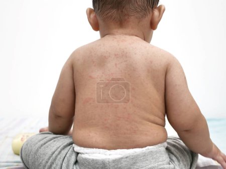 Little Asian baby girl with red rash on her skin, measles or chicken pox on newborn 