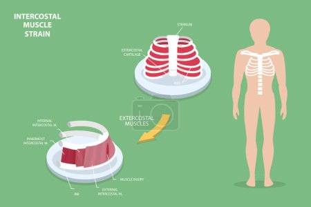 Illustration for 3D Isometric Flat Vector Conceptual Illustration of Intercostal Muscle Strain, Human Anatomy - Royalty Free Image