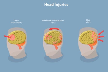 3D Isometrischer Flat Vector Konzeptuelle Illustration von Hirnverletzungen, Kopftrauma-Schema
