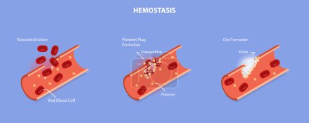Ilustración conceptual plana isométrica 3D del vector de la hemostasia, etapas del proceso de curación de heridas, vasoconstricción y formación de la ranura