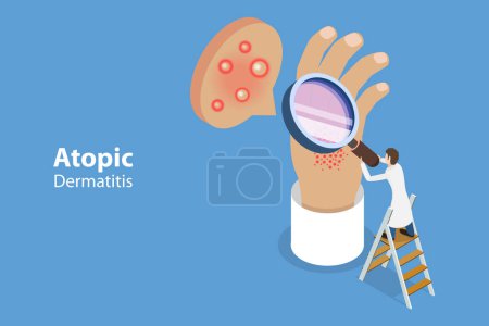 Illustration for 3D Isometric Flat Vector Conceptual Illustration of Atopic Dermatitis, Patient Skin Allergic Reaction - Royalty Free Image