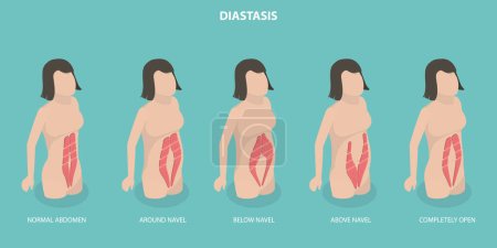 Ilustración conceptual del vector plano isométrico 3D de la diástasis muscular abdominal, problema de las mujeres después del embarazo