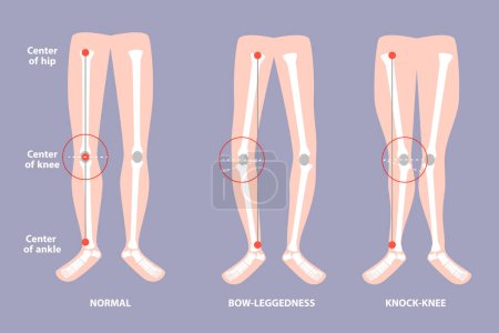 Illustration for 3D Isometric Flat Vector Conceptual Illustration of Valgus Deformity , Cosmetic Pathology - Royalty Free Image