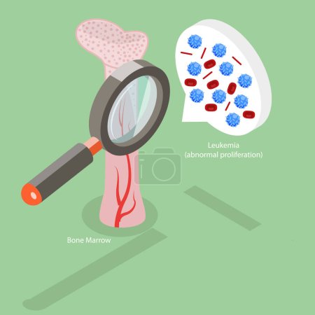 Illustration for 3D Isometric Flat Vector Conceptual Illustration of Leukemia Disease, Bone Marrow Anatomy - Royalty Free Image