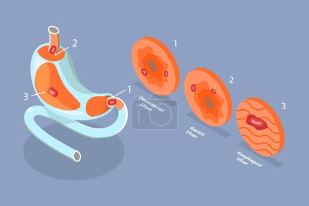 Illustration for 3D Isometric Flat Vector Conceptual Illustration of Peptic Ulcer Stomach Disease, Gastritis and Inflammation - Royalty Free Image