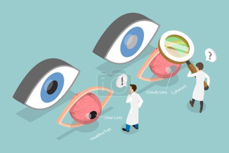 Illustration for 3D Isometric Flat Vector Conceptual Illustration of Cataract, Ophthalmology, Eye Surgery - Royalty Free Image