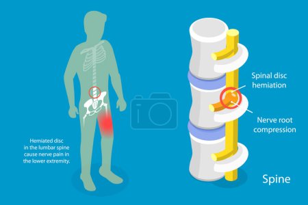 Illustration for 3D Isometric Flat Vector Conceptual Illustration of Sciatica Nerve Pain, Disc Degeneration - Royalty Free Image