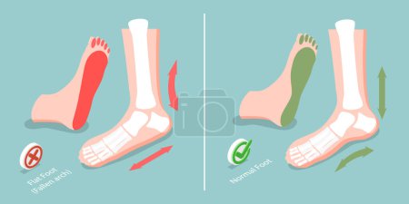Ilustración de Ilustración conceptual del vector plano isométrico 3D del pie plano, diferencia entre los pies enfermos y sanos - Imagen libre de derechos