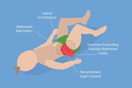 Ilustración de Ilustración conceptual del vector plano isométrico 3D de Gastroschisis, ombligo abdominal del dolor - Imagen libre de derechos