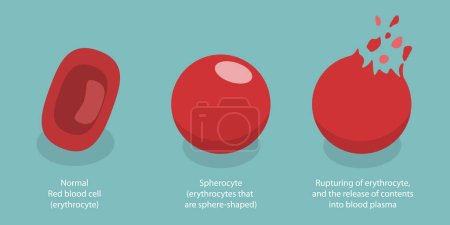Téléchargez les illustrations : Illustration conceptuelle 3D du vecteur plat isométrique de l'hémolyse, destruction des globules rouges - en licence libre de droit