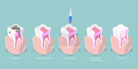 Ilustración conceptual del vector plano isométrico 3D de la caries dental, carta del tratamiento del canal de raíz
