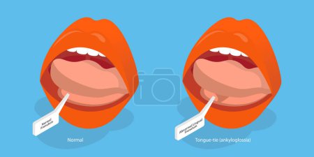 Illustration for 3D Isometric Flat Vector Conceptual Illustration of Ankyloglossia, Short Lingual Frenum That Interferes with Normal Tongue Movement. - Royalty Free Image