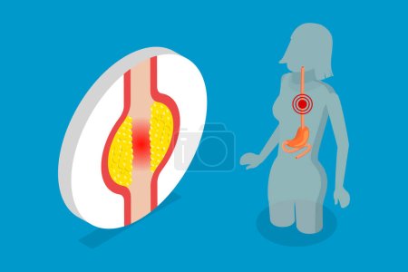 Ilustración de Ilustración conceptual plana isométrica 3D del carcinoma esofágico, sistema digestivo humano - Imagen libre de derechos