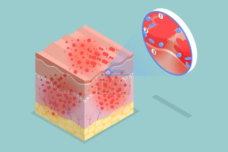 Illustration for 3D Isometric Flat Vector Conceptual Illustration of Atopic Dermatitis, Eczema Symptoms - Royalty Free Image