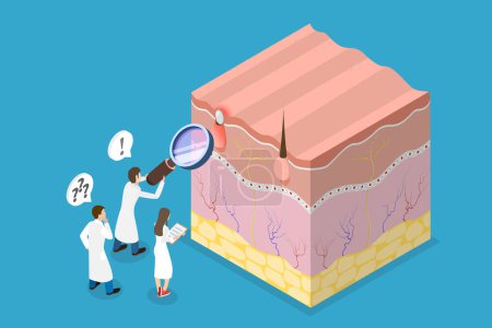 Illustration for 3D Isometric Flat Vector Conceptual Illustration of Acne Vulgari, Formation of Skin Pimple - Royalty Free Image