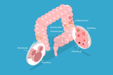 Illustration for 3D Isometric Flat Vector Conceptual Illustration of Diverticulosis And Diverticulitis, Medical Structure and Location - Royalty Free Image
