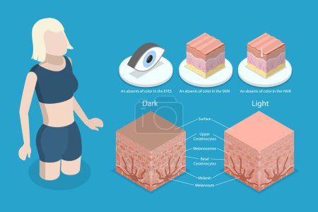 Illustration for 3D Isometric Flat Vector Conceptual Illustration of Albinism, Compared Normal Skin Cross Section with Lack of Melanocyte - Royalty Free Image
