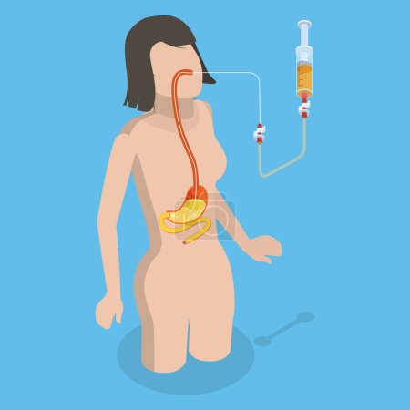 Illustration for 3D Isometric Flat Vector Conceptual Illustration of PEG, Nasogastric Tube Passed Through the Nose to Stomach - Royalty Free Image