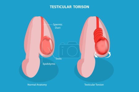 Ilustración de Ilustración conceptual plana isométrica 3D del torison testicular, desorden masculino del sistema reproductivo - Imagen libre de derechos