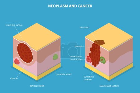 Ilustración conceptual de vectores planos isométricos 3D de neoplasia y cáncer, desarrollo tumoral