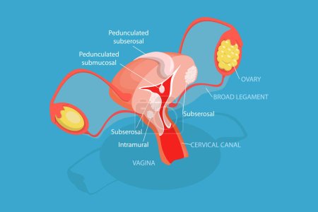 Ilustración de Ilustración conceptual de vectores planos isométricos 3D de tipos de fibromas uterinos, anatomía humana - Imagen libre de derechos