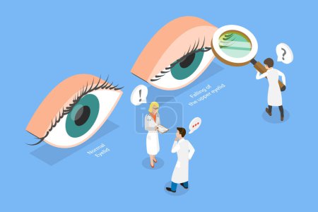 Illustration for 3D Isometric Flat Vector Conceptual Illustration of PTOSIS, Srooping of the Upper Eyelid - Royalty Free Image
