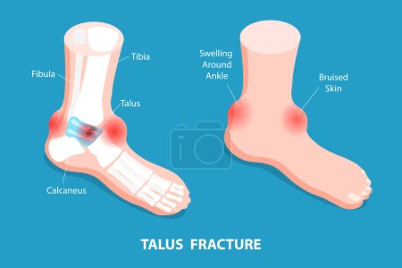 Illustration for 3D Isometric Flat Vector Conceptual Illustration of Talus Fracture, Ankle Trauma - Royalty Free Image