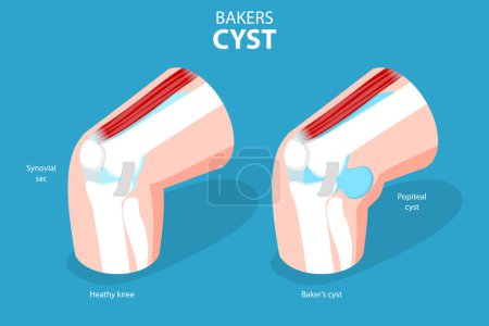 Illustration for 3D Isometric Flat Vector Conceptual Illustration of Bakers CYST, Traumatology and Prthopedics - Royalty Free Image