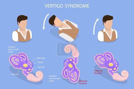 3D Isometric Flat Vector Conceptual Illustration of Vertigo Syndrome , BPPV
