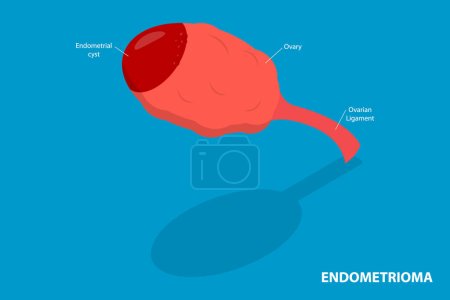 Téléchargez les illustrations : Illustration conceptuelle 3D vecteur plat isométrique de l'endométriome, kyste ovarien - en licence libre de droit