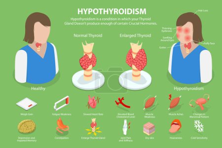 Ilustración conceptual isométrica 3D del hipotiroidismo, enfermedad de la glándula tiroides