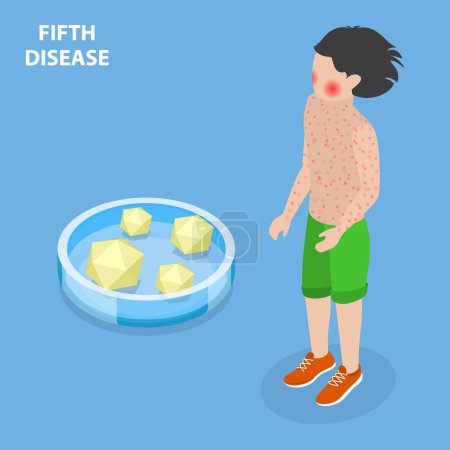 Téléchargez les illustrations : 3D Isometric Flat Vector Conceptual Illustration of Fifth Disease, Kid Disorder - en licence libre de droit