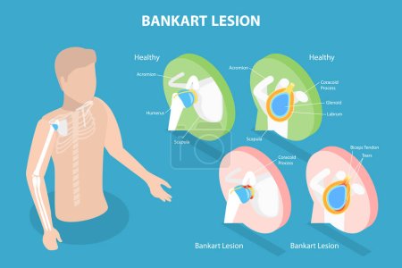 Illustration for 3D Isometric Flat Vector Conceptual Illustration of Bankart Lesion, Educational Diagram - Royalty Free Image