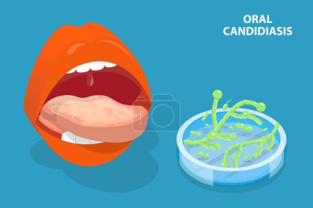 Téléchargez les illustrations : Illustration conceptuelle 3D vecteur plat isométrique de la candidose orale, infection à levures - en licence libre de droit