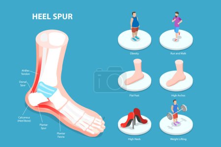 Illustration for 3D Isometric Flat Vector Conceptual Illustration of Heel Spur, Calcaneal Bone Condition - Royalty Free Image