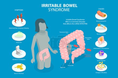 Illustration for 3D Isometric Flat Vector Conceptual Illustration of Irritable Bowel Syndrome, Stomach Problem - Royalty Free Image