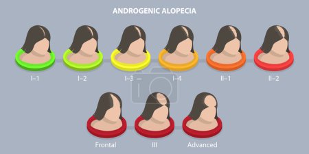 Ilustración de Ilustración conceptual plana isométrica 3D del alopecia androgénico, progreso calvo - Imagen libre de derechos