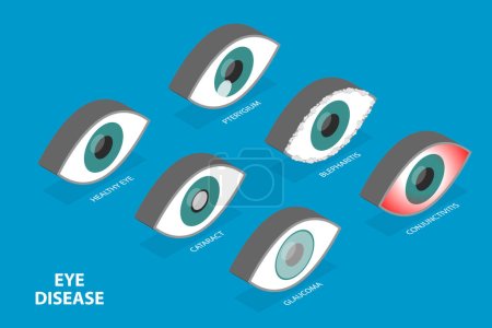 Téléchargez les illustrations : Ensemble de yeux vectoriels plats isométriques 3D avec différents problèmes, santé oculaire et visuelle humaine - en licence libre de droit