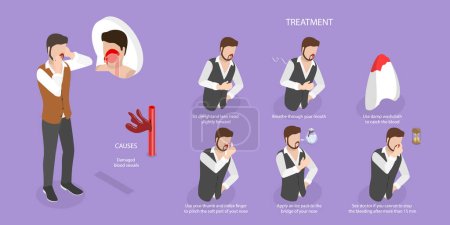 Illustration for 3D Isometric Flat Vector Conceptual Illustration of Nose Bleeding, Causes and Treatment - Royalty Free Image