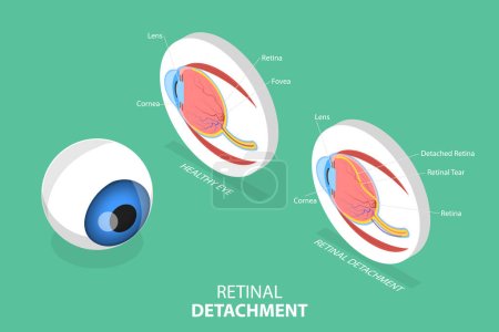 Ilustración conceptual plana isométrica 3D del desprendimiento de retina, diagrama educativo médico