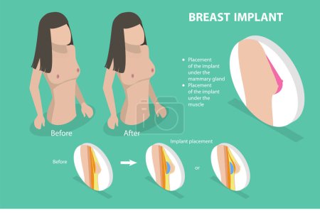 Illustration for 3D Isometric Flat Vector Conceptual Illustration of Breast Implant, Bust Enhancement Operation - Royalty Free Image