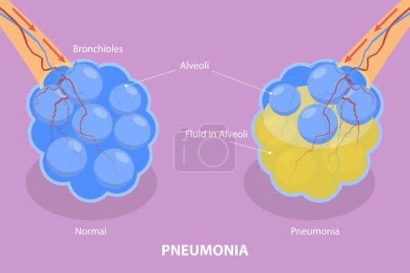 Illustration for 3D Isometric Flat Vector Illustration of Pneumonia, Lung Infection - Royalty Free Image