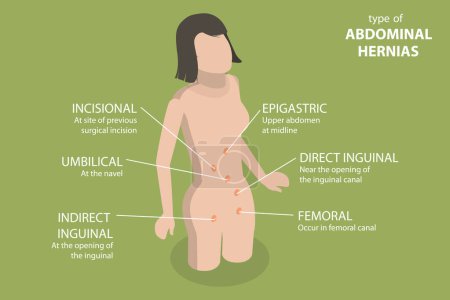 Illustration for 3D Isometric Flat Vector Illustration of Type Of Abdominal Hernias, Inguinal Hernia - Royalty Free Image