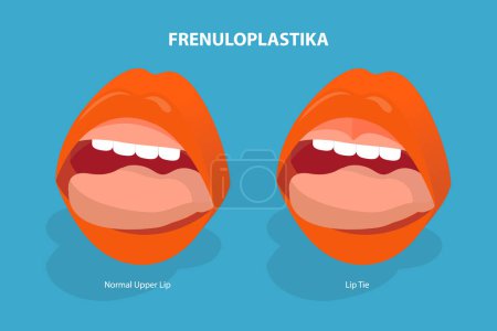 Téléchargez les illustrations : Illustration vectorielle plane isométrique 3D de Frenuloplastika, cravate de lèvre avant et après la chirurgie - en licence libre de droit