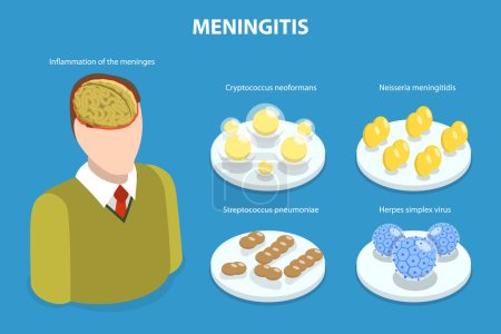 Ilustración de Ilustración plana isométrica 3D del vector de la meningitis, enfermedad meningocócica, inflamación peligrosa de las meninges - Imagen libre de derechos