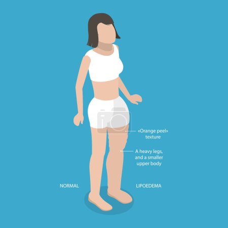 3D Isometric Flat Vector Illustration of Lipoedema, Overweight Issues
