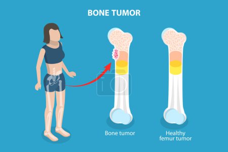 Téléchargez les illustrations : Illustration vectorielle plane isométrique 3D de la tumeur osseuse, problème orthopédique - en licence libre de droit