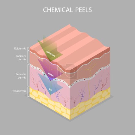 Illustration for 3D Isometric Flat Vector Illustration of Skin Chemical Peel, Beauty Aesthetic Treatment - Royalty Free Image